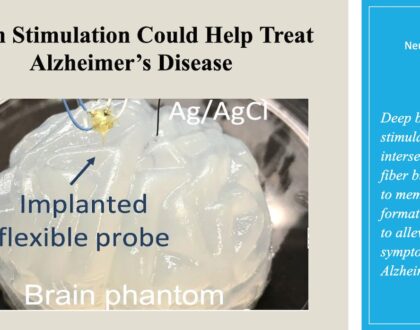 Brain Stimulation Could Help Treat Alzheimer’s Disease